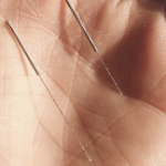 acupuncture needles in the palm of a hand
